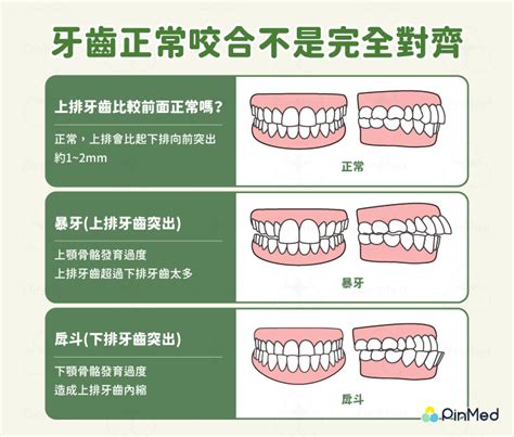 上排牙齒蓋住下排牙齒|深咬也是一種咬合問題！有7種可能原因與6種風險 